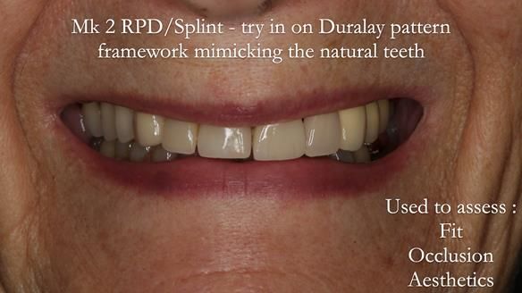 Newsletter 51 Managing Anne’s failing dentition with distal extension base RPD/Splint FULL PROTOCOL