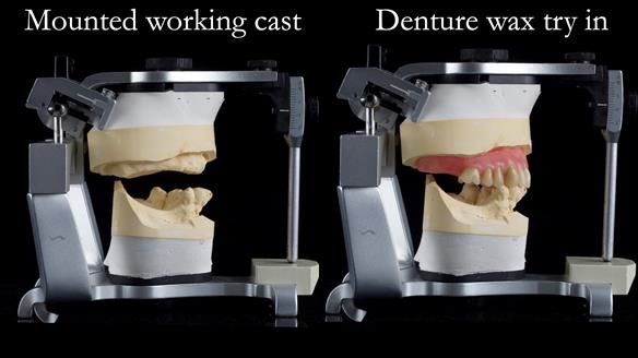 Newsletter 54 case presentation upper complete denture and lower Scandinavian designed hygienic partial denture for David
