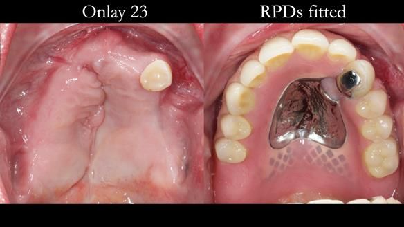 Newsletter 55 Provision of metal based partial dentures for Zephyrine with a repaired cleft lip and palate