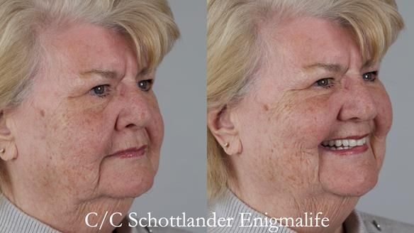 Replacing Madeline’s Complete denture FULL PROTOCOL