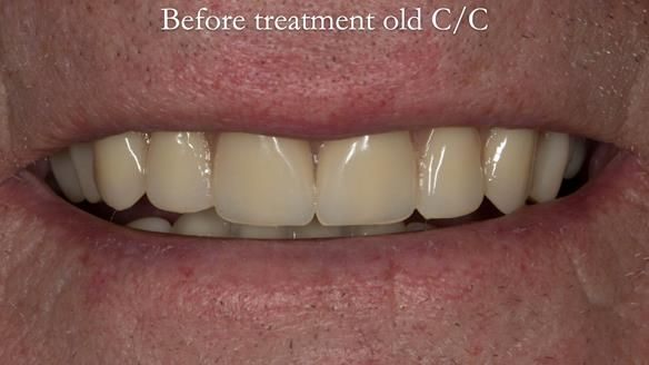 Complete denture Class II div 2 deep overbite Newsletter 39