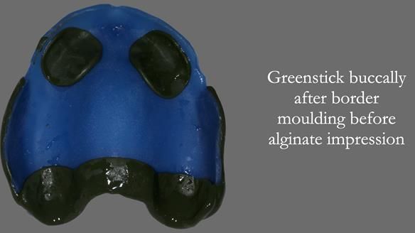 Newsletter 53 showing the making and fitting of ultra life-like dentures for Valena