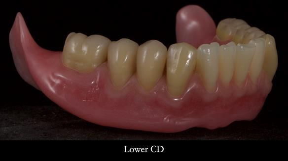 Newsletter 83: Sheila’s Complete Denture Success