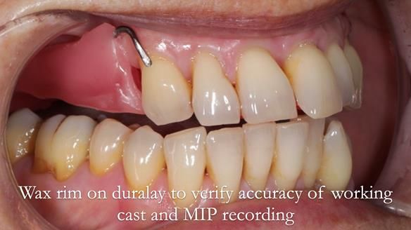 Newsletter 56 showing the making and fitting of a bilateral free end saddle upper removable partial denture (RPD) for patient with pemphigus