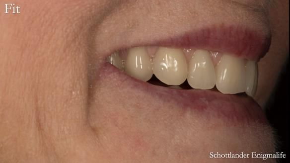 Newsletter 75: Marion’s case - Step-by-step complete denture workflow