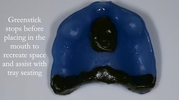 Newsletter 57 showcases the making and fitting process of implant-supported complete dentures for Alisdair