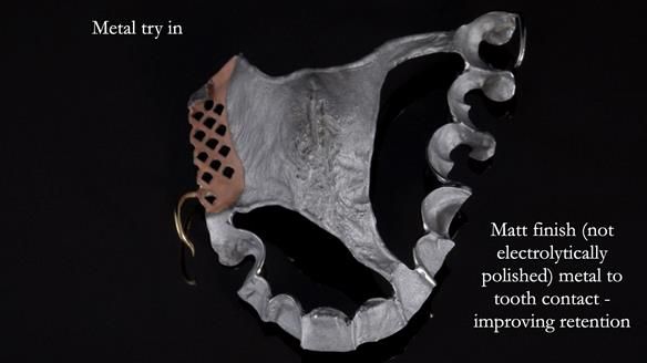 Finlay's Newsletter 64 case study - provision of a Kennedy class 2 metal based Scandinavian RPD for Ian