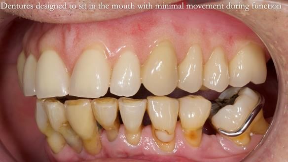 Newsletter 54 case presentation upper complete denture and lower Scandinavian designed hygienic partial denture for David