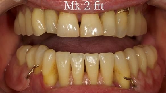 Finlay's Case Study Newsletter 40 - Immediate Mk 1 RPD to Definitive Mk 2 RPD - full protocol