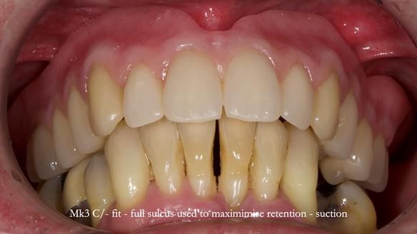 Newsletter 77: Jeremy’s case – immediate complete upper denture
