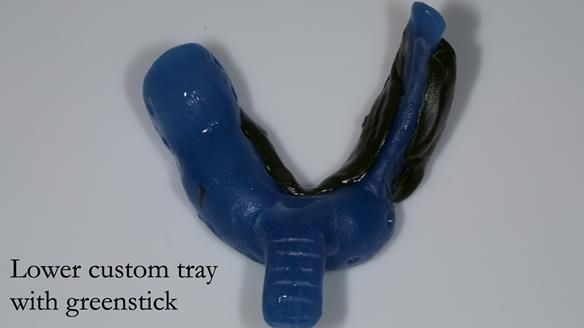 Newsletter 55 Provision of metal based partial dentures for Zephyrine with a repaired cleft lip and palate