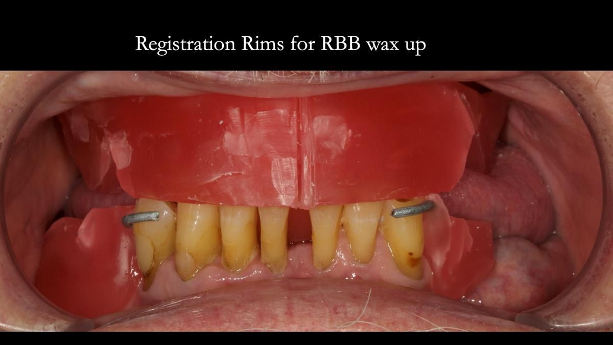 Newsletter 87 – Father Peter: A Partial Denture that needed Minor Miracle