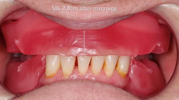 Newsletter 52 Managing Jo’s failing dentition with extractions and Mk 1/Mk 2 complete upper dentures and lower partial dentures FULL PROTOCOL