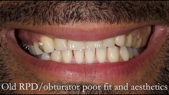 Acrylic based partial denture/obturator had poor, retention and support Obturator section was in poor condition. The Adams clasp were causing inflammation of the gingival margins. The clasp on the UR3 was visible resulting in poor appearance. Reduced lip