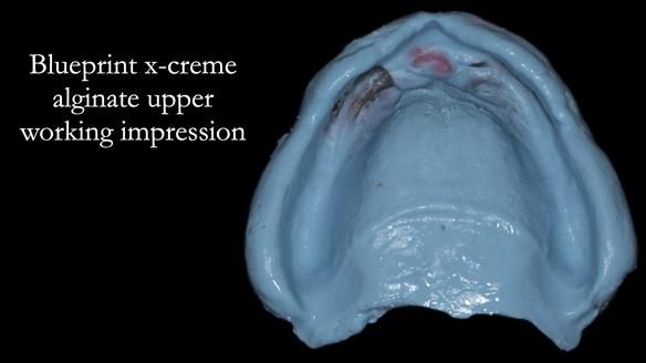 Newsletter 75: Marion’s case - Step-by-step complete denture workflow