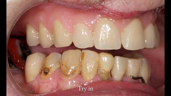 Newsletter 55 Provision of metal based partial dentures for Zephyrine with a repaired cleft lip and palate