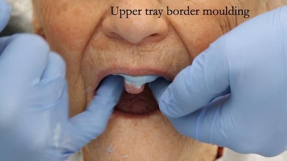 Solving Linda’s Failed “All on 4” implant bridges - full protocol Newsletter 42