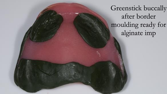 Managing poor implant positioning with complete dentures and Locator attachments - full protocol Newsletter 41