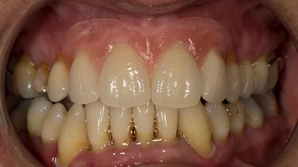 Finlay's Newsletter 63 Case study provision of metal based Scandinavian RPD - functional 10 years on
