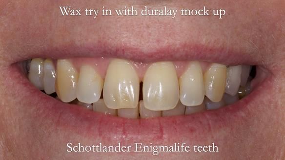 Solving Sue's failed implants with metal based RPD - full protocol Newsletter 43