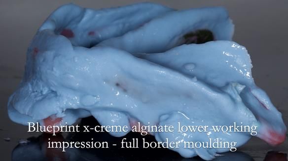 Newsletter 44 - extreme removable prosthodontics – engineering a super-strong and ultra-thin over denture