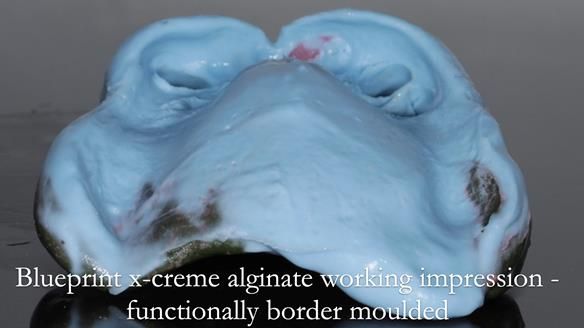 Finlay's Newsletter 59 Ultra hard partial dentures made for Gill