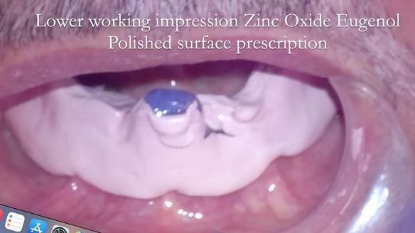 Finlay's Newsletter 62 provision of extractions and metal based complete dentures for Rafique