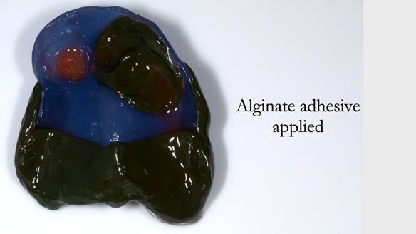 Newsletter 55 Provision of metal based partial dentures for Zephyrine with a repaired cleft lip and palate