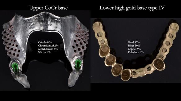 Newsletter 76: Jackie’s case – Telescopic overdenture & precision RPD (the tricky truth!)