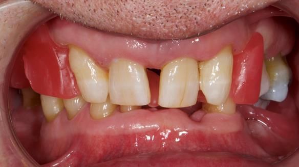 Newsletter 86 Peter the Architect — precision removable partial dentures case study