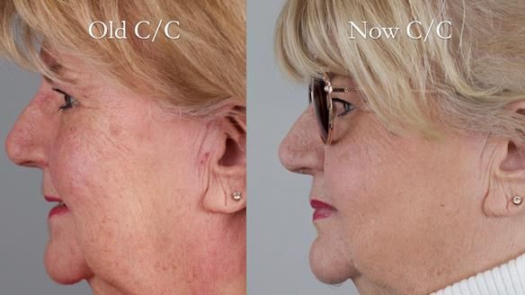 Replacing Madeline’s Complete denture FULL PROTOCOL