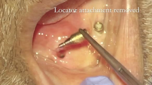 Managing poor implant positioning with complete dentures and Locator attachments - full protocol Newsletter 41
