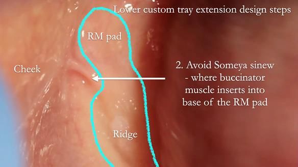 Newsletter 50 Special edition Complete Dentures FULL PROTOCOL