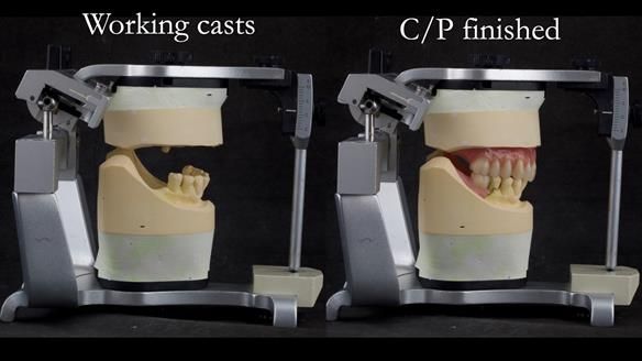 Solving Linda’s Failed “All on 4” implant bridges - full protocol Newsletter 42