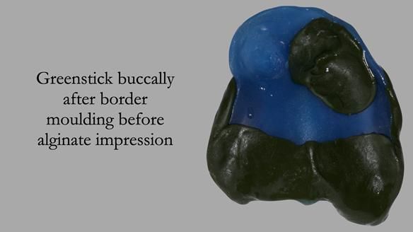 Newsletter 55 Provision of metal based partial dentures for Zephyrine with a repaired cleft lip and palate