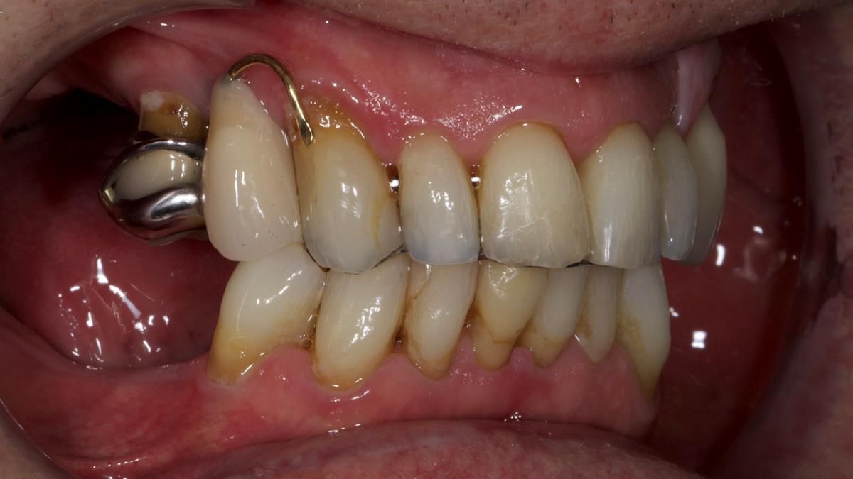 Newsletter 89 – Simon: A Challenging Kennedy Class II Division 1 Upper CoCr Partial Denture with a High Smile Line