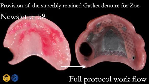 Finlay's Newsletter 58 Gasket upper partial denture for Zoe