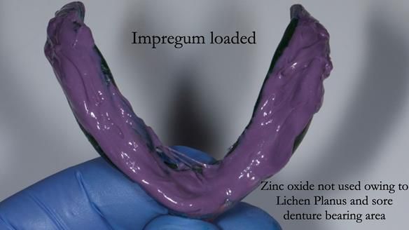 Replacing Madeline’s Complete denture FULL PROTOCOL