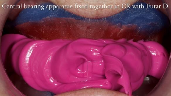 Newsletter 83: Sheila’s Complete Denture Success