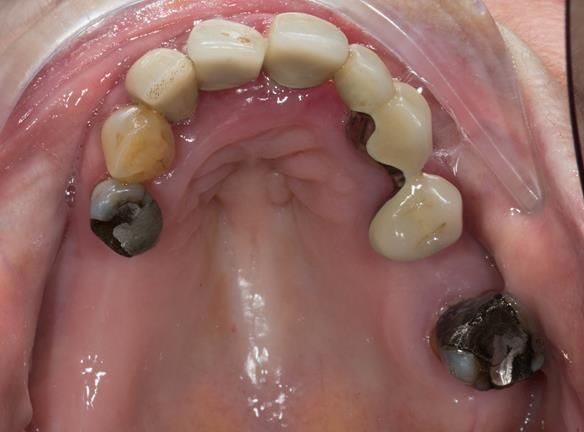 Figure 6 Pre - treatment. Failing upper teeth