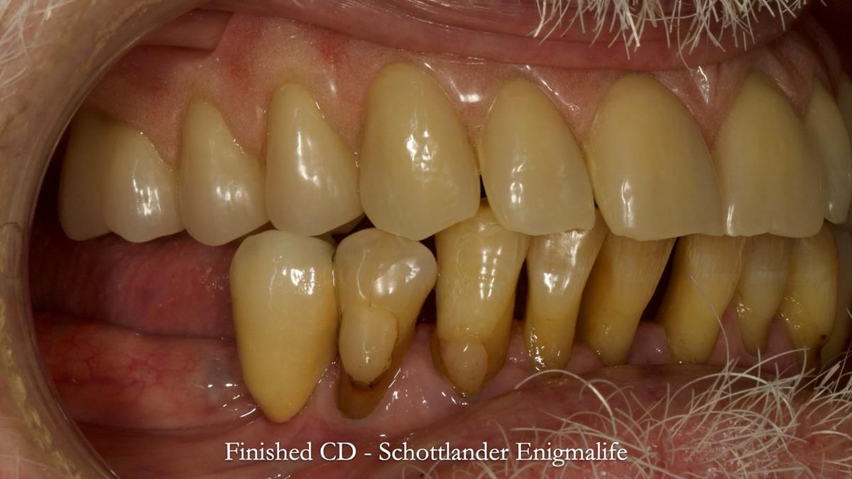 Newsletter 87 – Father Peter: A Partial Denture that needed Minor Miracle