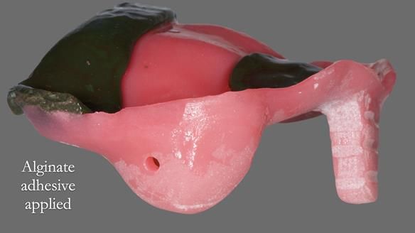 Newsletter 52 Managing Jo’s failing dentition with extractions and Mk 1/Mk 2 complete upper dentures and lower partial dentures FULL PROTOCOL