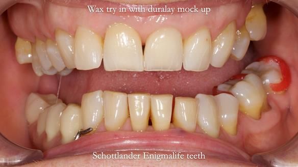 Finlay's Newsletter 61 provision of a lower unilateral free end saddle metal based partial denture for Joyce