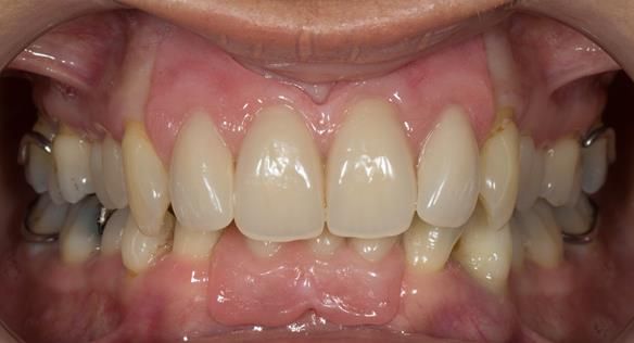 Figure 78 Definitive dentures fitted 9 months after extractions. Schottlander Enigmalife teeth