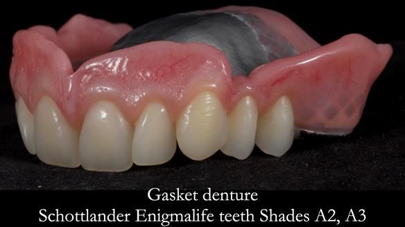 Finlay's Newsletter 58 Gasket upper partial denture for Zoe