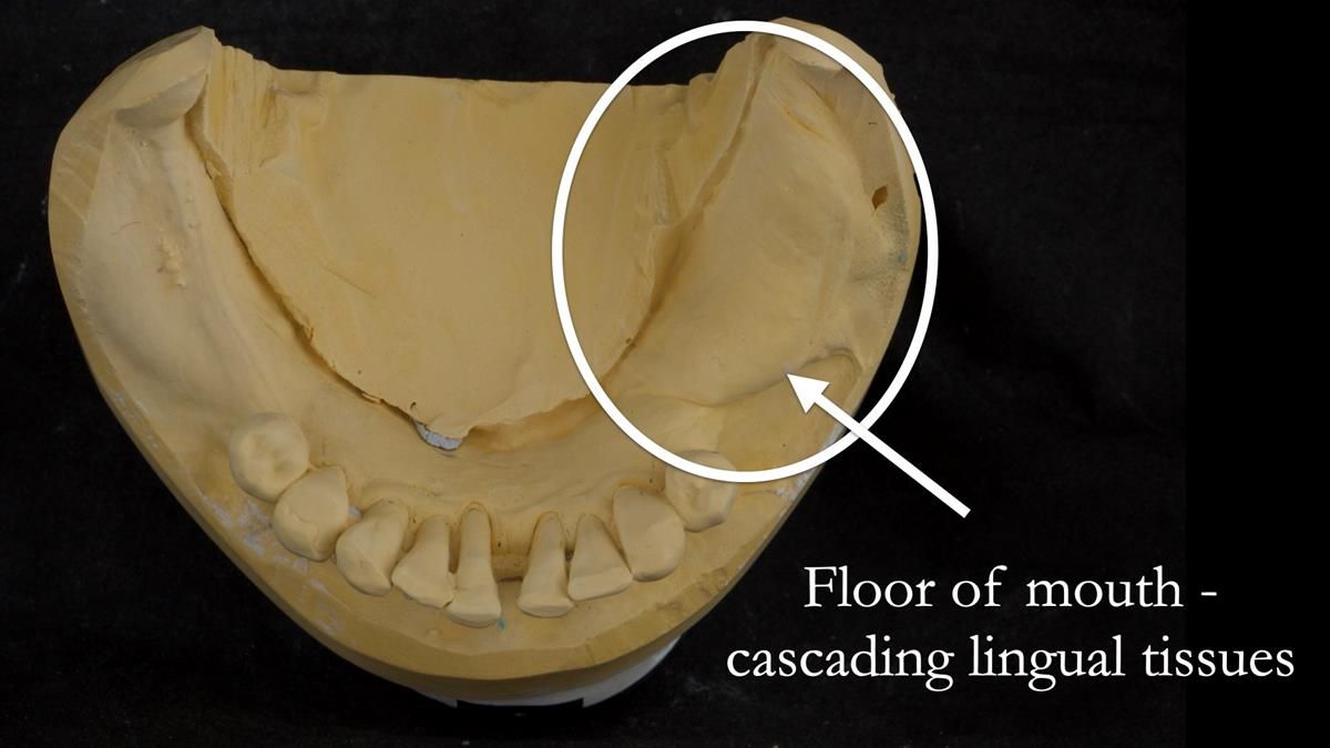 Newsletter 87 – Father Peter: A Partial Denture that needed Minor Miracle