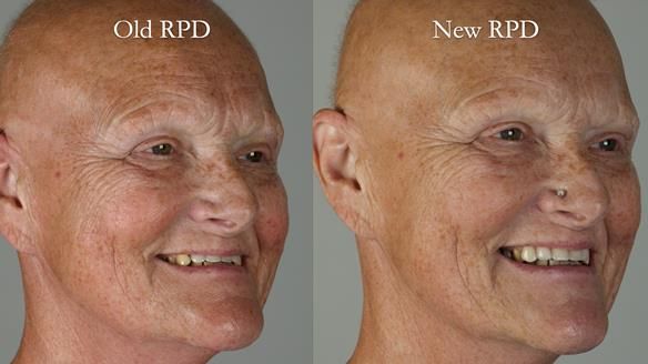 Newsletter 81 - Pam’s Story — how a partial denture changed her life (+ live walkthrough this Thursday)