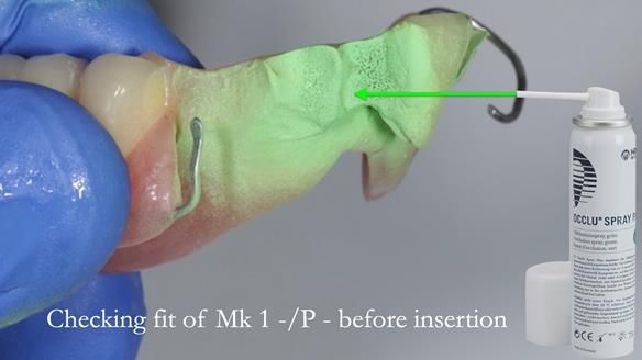 Newsletter 54 case presentation upper complete denture and lower Scandinavian designed hygienic partial denture for David