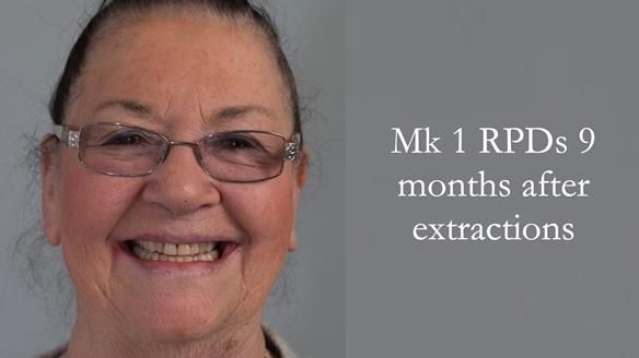 Finlay's Case Study Newsletter 40 - Immediate Mk 1 RPD to Definitive Mk 2 RPD - full protocol