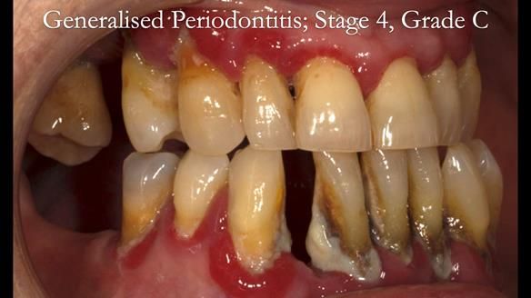 Finlay's Case Study Newsletter 40 - Immediate Mk 1 RPD to Definitive Mk 2 RPD - full protocol